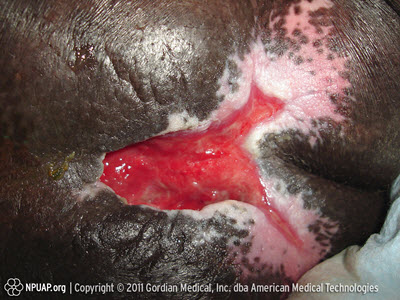 Warning - Images of Pressure Sores - Graphic