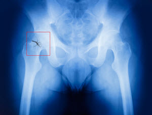 Philadelphia elderly broken hip